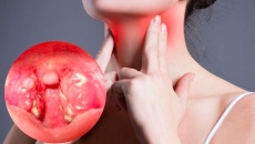 Người bị đau họng nên ăn gì để nhanh cải thiện?