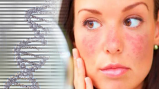 Yếu tố di truyền có ảnh hưởng đến bệnh lupus ban đỏ không?