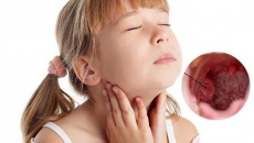 Biến chứng viêm amidan quá phát độ 4 ở trẻ em - Cha mẹ chớ chủ quan