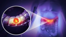 Cẩn thận với 5 dấu hiệu cảnh báo ung thư đại trực tràng