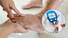 Mắc đái tháo đường, bị sưng 2 chân là biến chứng gì?