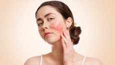 Lupus ban đỏ và ảnh hưởng đến sức khỏe toàn diện