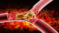 Mỡ máu cao: Sát thủ thầm lặng của hệ tim mạch