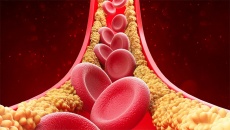 Cholesterol cao - 'thủ phạm' âm thầm bào mòn động mạch vành