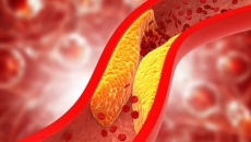 Mỡ máu cao là bao nhiêu và cách điều chỉnh