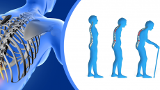 Loãng xương: Thủ phạm âm thầm gây tàn phế ở người cao tuổi