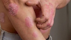 Ngày vảy nến thế giới: Nâng cao kiến thức cho người bệnh!