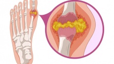 Nguy cơ từ các hạt tophi do bệnh gout  