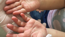 Chăm sóc trẻ bị tay chân miệng tại nhà đúng cách 