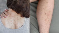 Giải pháp giúp làn da cơ thể mịn màng, hết mụn