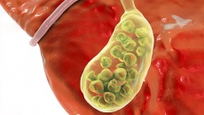 Có đám sỏi mật 27mm phải làm sao?