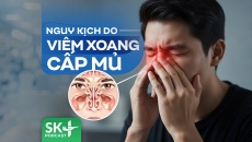 Podcast: Nguy kịch do viêm xoang cấp mủ