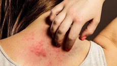 Vì sao bệnh vảy nến trở nặng khi trời lạnh?