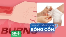Podcast: Chăm sóc vết bỏng cồn thế nào để tránh nguy cơ nhiễm trùng?