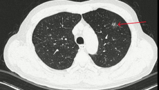 Đi khám sỏi thận, phát hiện ung thư phổi giai đoạn sớm nhờ AI