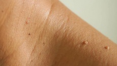 5 dấu hiệu cảnh báo bệnh đái tháo đường bạn không nên bỏ qua