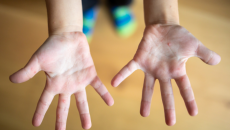 Cha mẹ cần cảnh giác với bệnh tay chân miệng ở trẻ