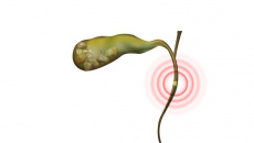 Có sỏi ống mật chủ 36x12mm: Dùng TPBVSK Kim Đởm Khang được không?