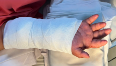 Nối lại bàn tay đứt lìa cho sản phụ, sau 2 tháng được 'ghép tạm' vào chân