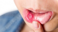 Dấu hiệu ở miệng chứng tỏ bạn thiếu vitamin B12