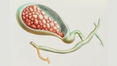 Sỏi mật 8,9mm và 15mm chưa có biến chứng có nguy hiểm không?