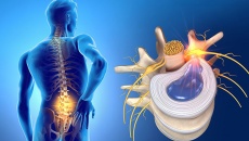 7 nguyên nhân dẫn đến thoát vị đĩa đệm