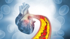 Tăng huyết áp kèm cholesterol cao: “Bộ đôi” đẩy nhanh xơ vữa mạch