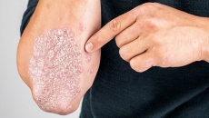 Chìa khóa giúp người bệnh vảy nến ổn định triệu chứng lâu dài