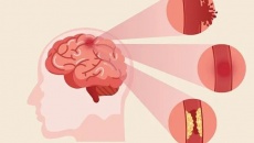 Dấu hiệu tai biến mạch máu não thường bị bỏ qua 