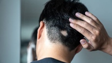 Lầm tưởng thường gặp về chứng rụng tóc từng mảng