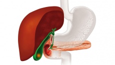 Sỏi mật 25mm dùng TPBVSK Kim Đởm Khang được không?