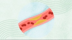 Bạn có thể mắc bệnh mạch vành dù không hề bị đau tức ngực?