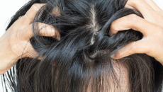 5 yếu tố âm thầm khiến vảy nến da đầu tái phát liên tục