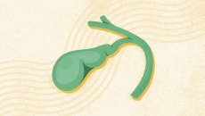 Có sỏi mật 15mm, hay bị đau hạ sườn phải nên xử trí thế nào?