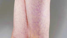 Dấu hiệu lạ trên da có thể cảnh báo vấn đề tim mạch