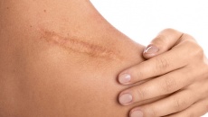 Cùng là vết thương, vì sao mặt ít sẹo hơn cơ thể?