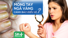 Podcast: Móng tay ngả vàng cảnh báo vấn đề gì?