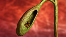 Sỏi túi mật 4,5mm dùng TPBVSK Kim Đởm Khang được không?