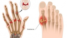 Chế độ ăn uống giúp giảm acid uric