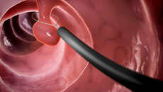 5 cách bảo vệ đại tràng, hạn chế nguy cơ ung thư từ polyp