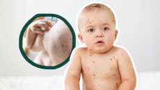 Cách giảm ngứa khi mắc thủy đậu