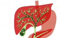 Sỏi gan 7,5mm nên mổ hay dùng cách tẩy sỏi gan 1 ngày?