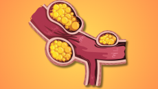 Xơ vữa động mạch: Nguyên nhân, mức độ nguy hiểm và giải pháp hỗ trợ phòng ngừa