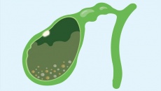 Có polyp túi mật và sỏi bùn túi mật cần cẩn trọng gì?