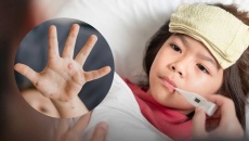 bệnh thủy đậu là gì và cách điều trị ra sao? 