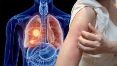 Dấu hiệu ngoài da cảnh báo u phổi
