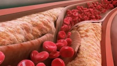 Xơ vữa động mạch hình thành như thế nào?  