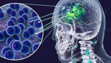 4 trường hợp tử vong do mắc viêm não mô cầu, Bộ Y tế phát cảnh báo