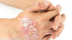 Bị vảy nến thể mảng cần lưu ý những gì?