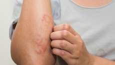 Viêm mao mạch dị ứng ở trẻ em có nguy hiểm không?